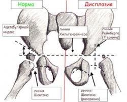 thumb_pre_1436297526__congenital_disloca